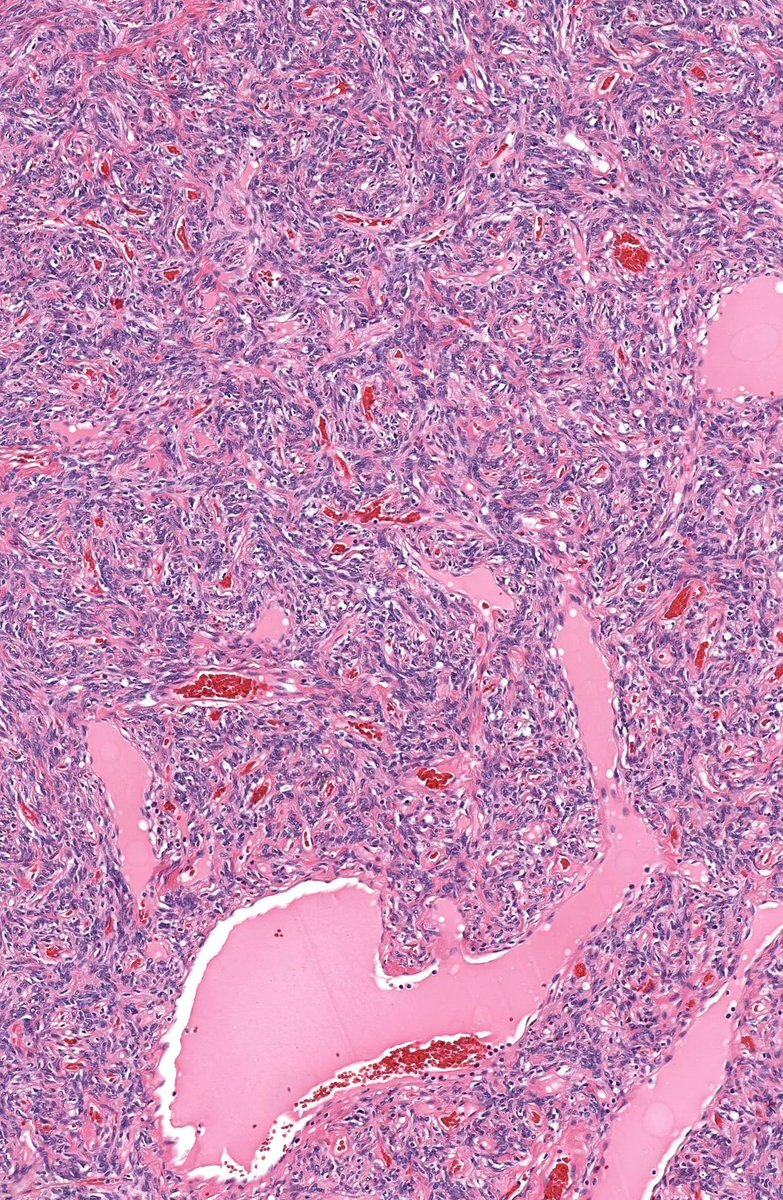 Diagnosis from 1 pic, or is it #TooCloseToDiagnose?
Answer🔬kikoxp.com/posts/17749
Video ⏯️ kikoxp.com/posts/4511&amp; kikoxp.com/posts/16801
Patterns kikoxp.com/posts/17762 &amp;kikoxp.com/posts/17769 
#BSTpath #pathologists #pathTwitter #dermpath #dermatology #dermtwitter