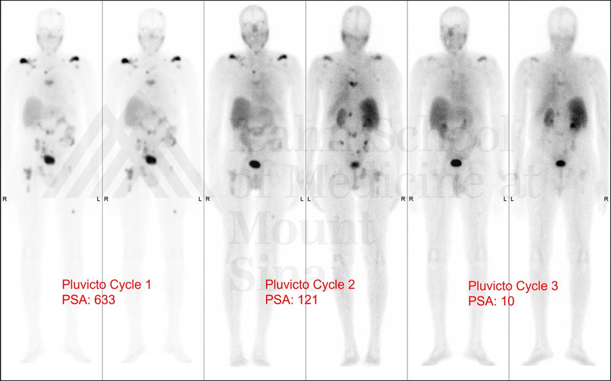 Amazing response to Pluvicto therapy. 98% decrease in PSA after only three cycles! Performance status and quality of life significantly improved. #nucmed #theranostics <a href="/RofskyMD/">Neil Rofsky, MD, MHA</a> <a href="/MountSinaiDMIR/">Mount Sinai Diag, Molecular, and Interv Radiology</a> <a href="/munirghesani/">Munir Ghesani</a>