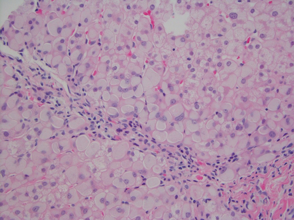 Teenager with elevated liver enzymes. Can you guess the clinical history? #pedipath #pathtwitter #path2path #GIpath #liverpath