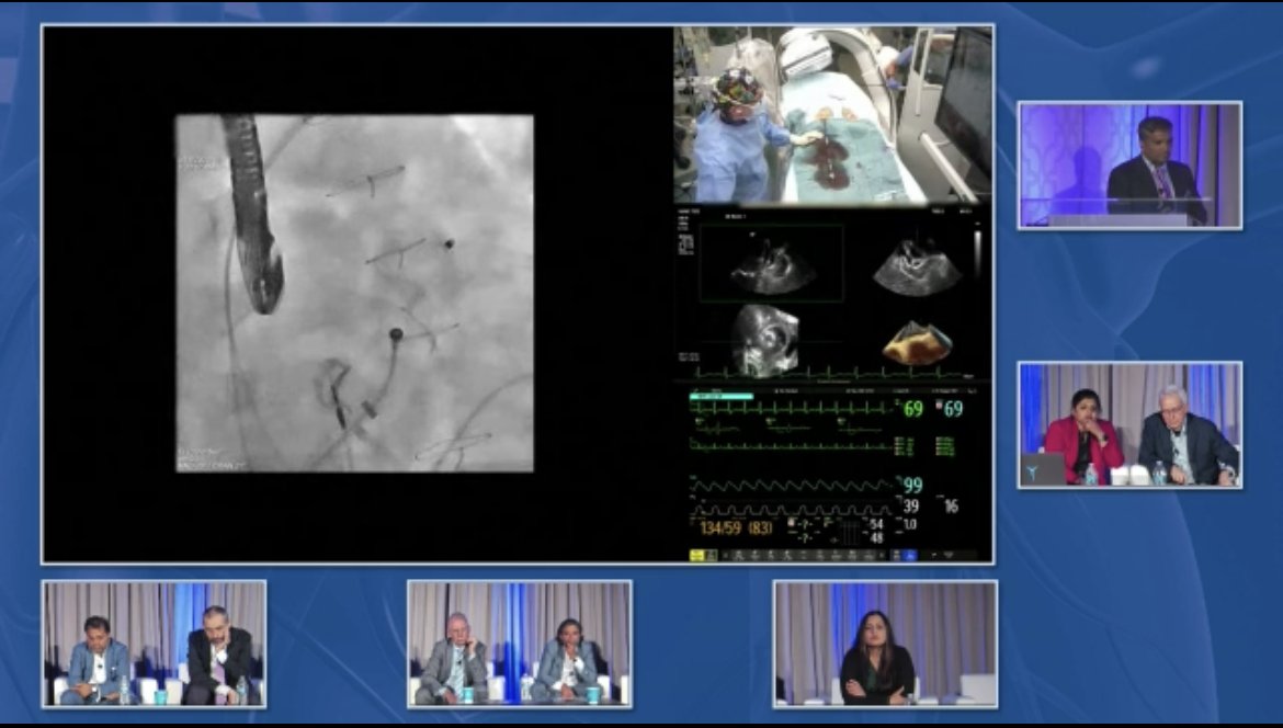 #epeeps #SPAF2023 Live Case Session featuring cases from @cellisvandyep from @VUMCDiscoveries and @RPHortonMD from @tcainstitute with moderators @Drdevignair @VivekReddyMD and panelists @SDoshiMD @natale_md @NeuzilPetr Join the Live Stream in Progress @ tinyurl.com/SPAFLive