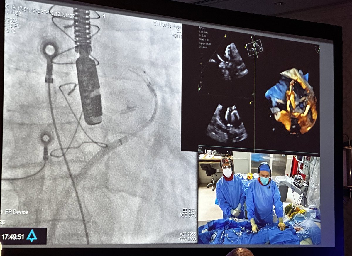 aalahmadmd's tweet image. Live case from @tcainstitute leak closure for LAAO device. #SPAF2023 #HRS23 @RPHortonMD