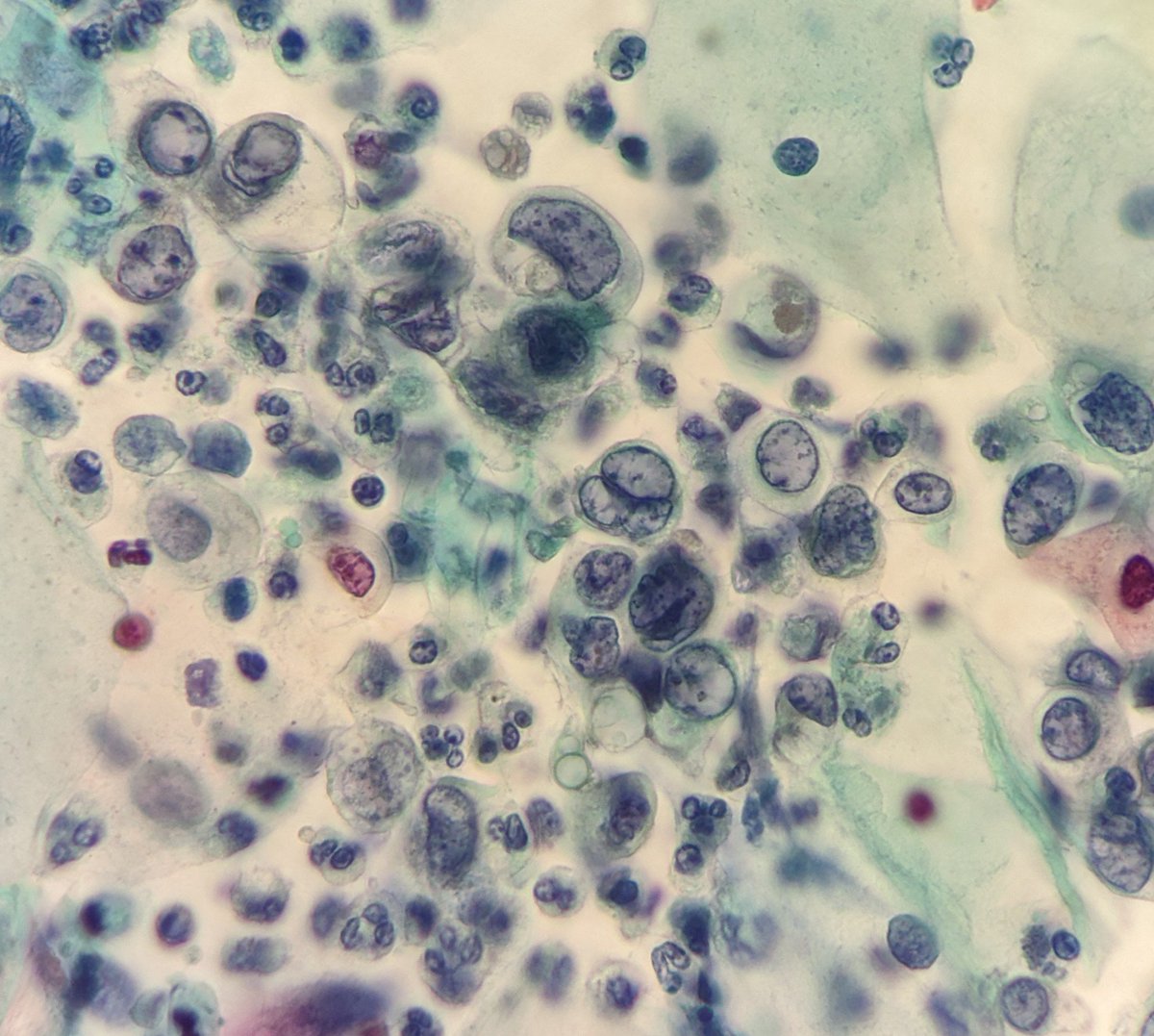 PSzwebel's tweet photo. SCC Convencional Pap Smear.
First PAPANICOLAOU 43 y/a https://t.co/8cz2LWyI6z