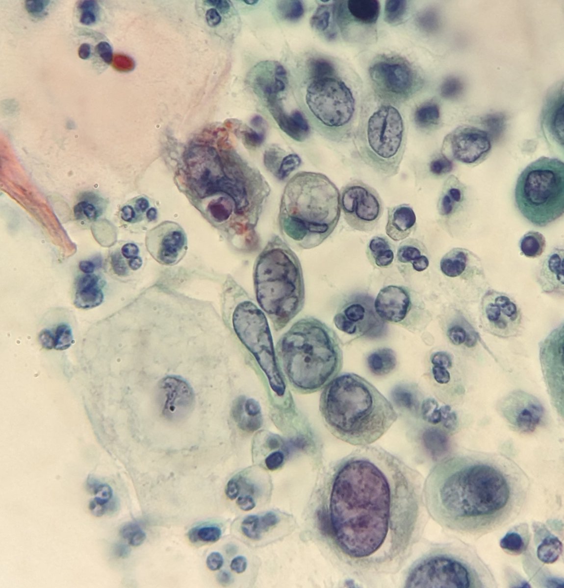 PSzwebel's tweet photo. SCC Convencional Pap Smear.
First PAPANICOLAOU 43 y/a https://t.co/8cz2LWyI6z