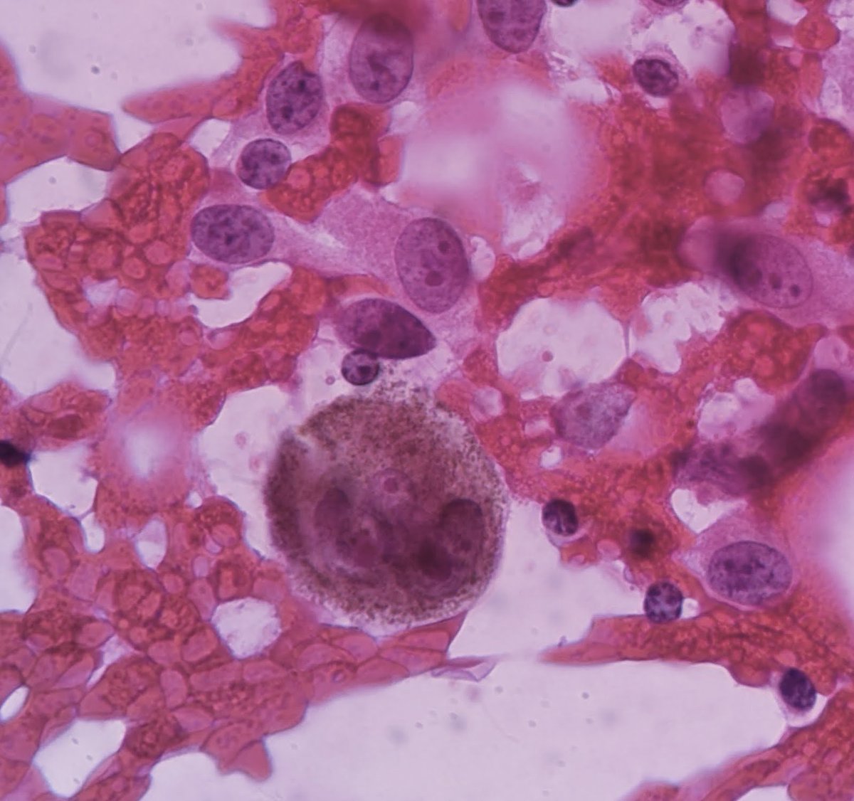 PSzwebel's tweet photo. Metastatic Axilary Lymph Node .
She has triple positive contralateral  Breast Cáncer and skin Melanoma in homolateral abdominal área 2,5mm breslow.
Metastatic Melanoma with pigmented cells https://t.co/7aSw5mDUjc