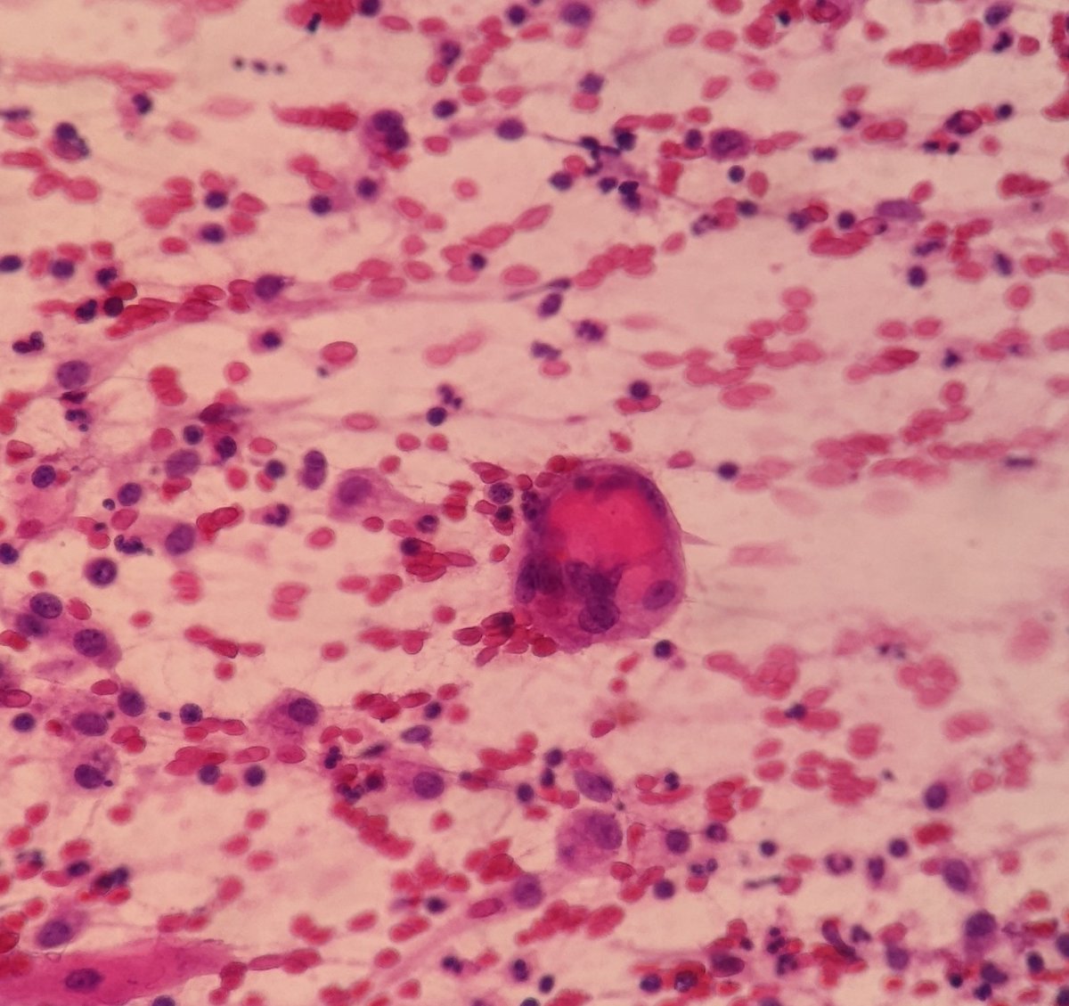 PSzwebel's tweet photo. Breast FNA.
INFECTED EPIDERMAL INCLUSION CYST
Superficial squamous cells, macrophages engulfin kerstin
Leucocites https://t.co/XnRpahXp9g
