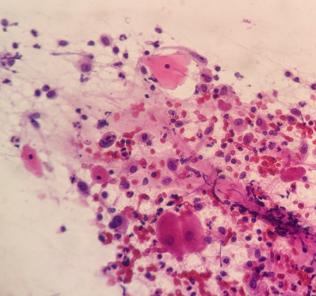 PSzwebel's tweet photo. Breast FNA.
INFECTED EPIDERMAL INCLUSION CYST
Superficial squamous cells, macrophages engulfin kerstin
Leucocites https://t.co/XnRpahXp9g