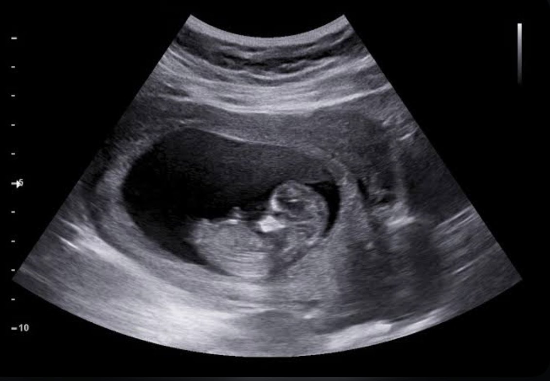 Vaish1807's tweet photo. Today I saw my lil munchkin for the very first time via Ultrasound..😍❤️🥹
#baby1 https://t.co/hEjAuhvIRT