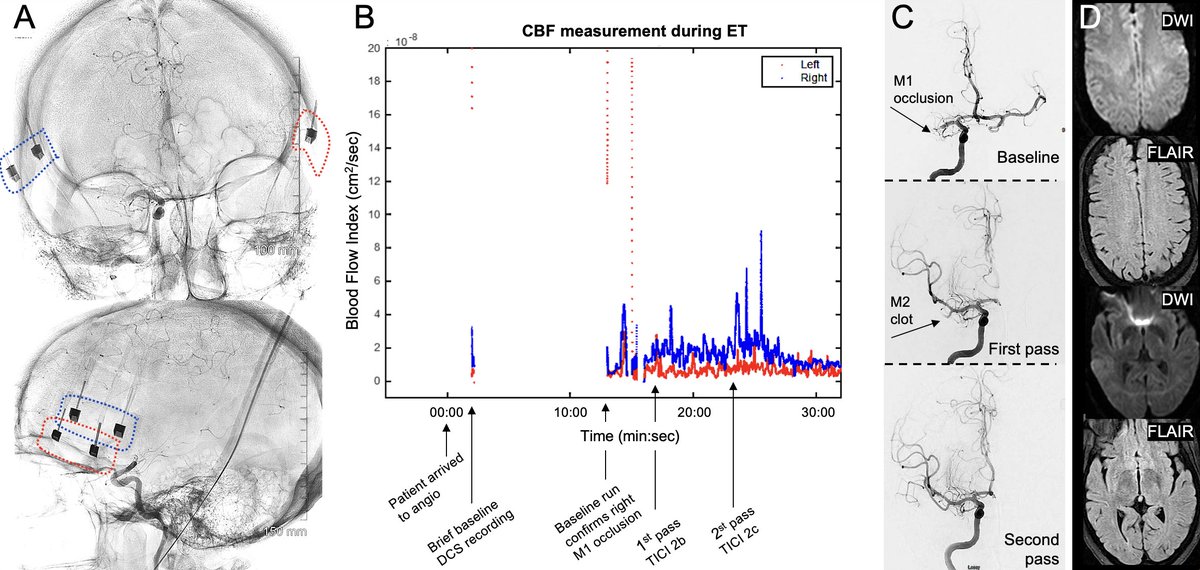 ⏲️🧠Real-time changes in brain perfusion in the angiosuite with <a href="/TropicsLab/">Ashwin Parthasarathy</a> <a href="/USFNeurosurgery/">University of South Florida Neurosurgery</a> <a href="/usfneurons/">University of South Florida Neurology Residency</a> <a href="/WaldoGuerrero82/">Waldo Guerrero</a> <a href="/KunalVakhariaMD/">Kunal Vakharia</a> - publication #1 from our latest NIH R21. More to come. Stay tuned..