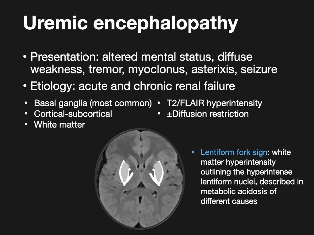 Radiopaedia's tweet photo. Lentiform fork sign in uremic encephalopathy. Images from our new Toxic &amp; Metabolic Brain Disorders online course by @francisdeng. Half price $12 offer ends this weekend! 

REGISTER: https://t.co/VBjH2T6YhA 

#neurorad #radres Case courtesy of Bahman Rasuli. https://t.co/UJTASvGtQK