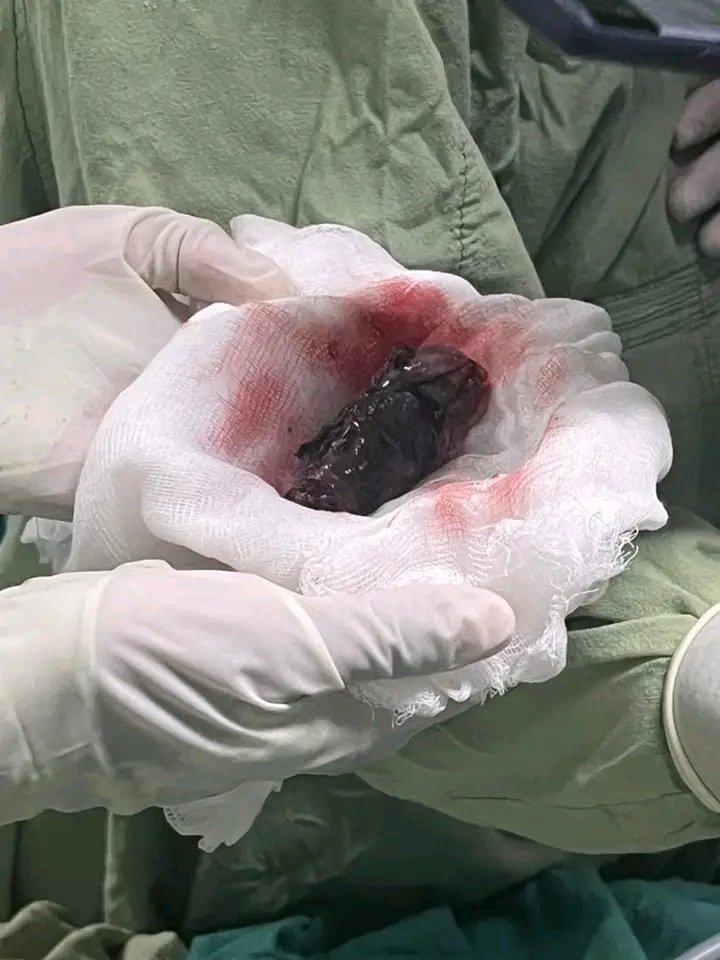 Enfisema bulloso del vértice. Servicio de Cirugía General. Vamos por más, por nuestros pacientes. <a href="/DPSHabana/">Dirección General de Salud La Habana</a>