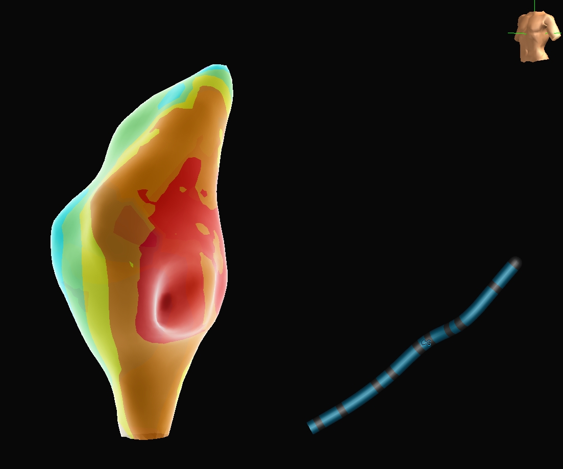 DimitrisKatsar6's tweet photo. A very nice example of the usefulness of the versatile HDGrid Advisor in mapping a non-sustained focal AT from the LA, very close to the transseptal punture. Wide breakthrough area on the right aspect of the IAS. https://t.co/6NQ3v5tcnK