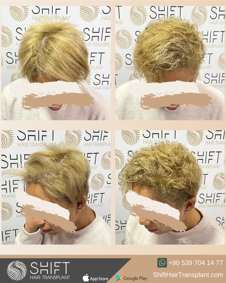 shifthairtr's tweet image. Before and after scalp micropigmentation for women in Turkey with SHIFT Hair in Istanbul

#ScalpMicroPigmentation #MicroPigmentation #SMP #HairTattoo #HairShading #MicroPigmentationTurkey #MicroPigmentationIstanbul #MicroPigmentationInTurkey #MicroPigmentationInIstanbul
