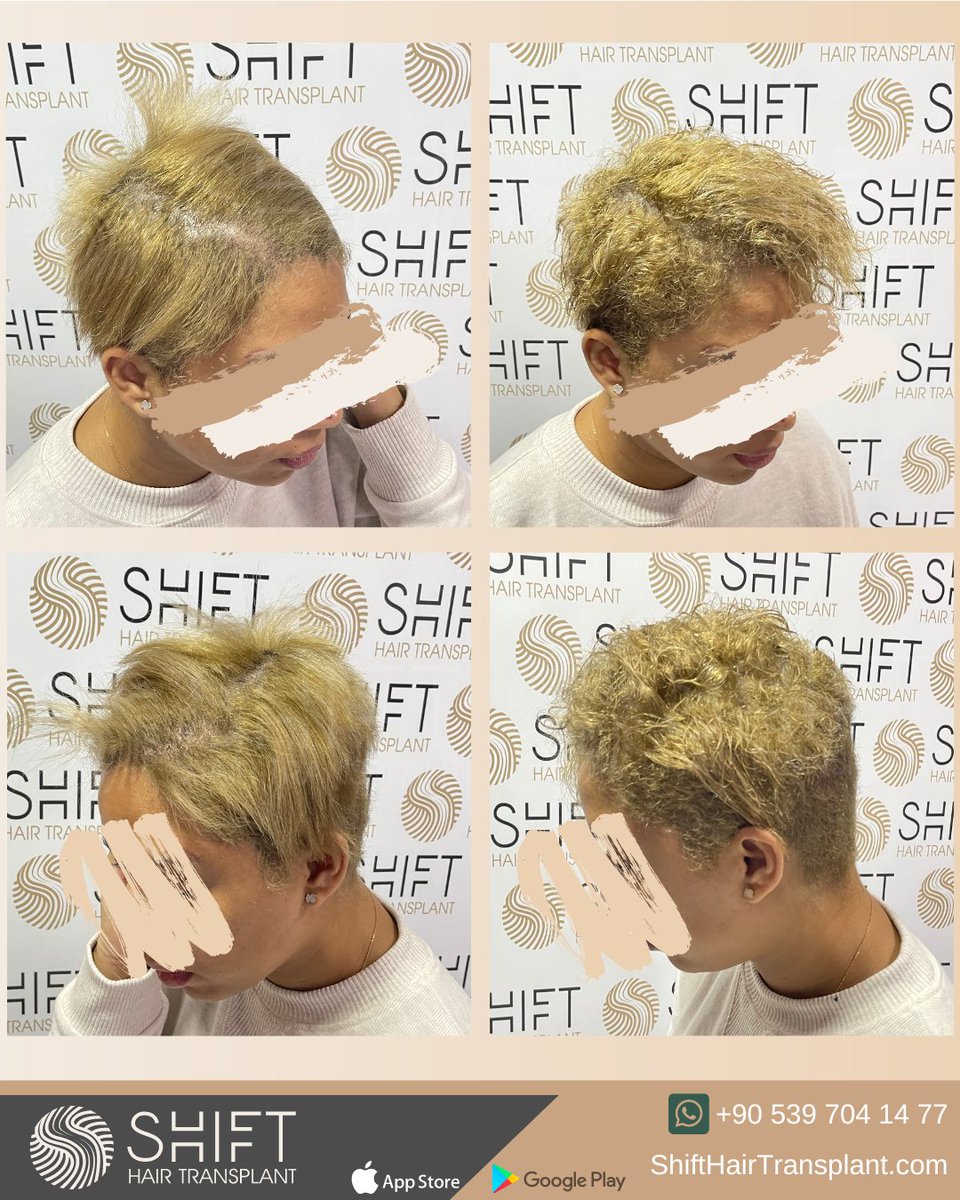 shifthairtr's tweet image. Before and after scalp micropigmentation for women in Turkey with SHIFT Hair in Istanbul

#ScalpMicroPigmentation #MicroPigmentation #SMP #HairTattoo #HairShading #MicroPigmentationTurkey #MicroPigmentationIstanbul #MicroPigmentationInTurkey #MicroPigmentationInIstanbul
