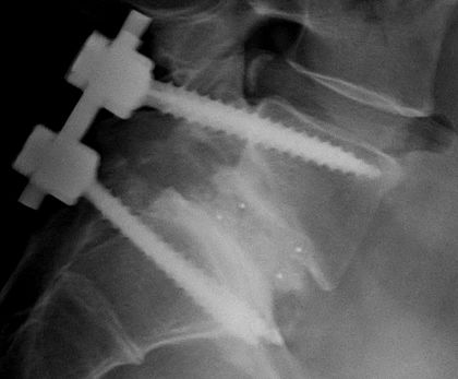 searcheng_in's tweet image. Spinal fusion is a neurosurgical or orthopedic surgical technique that joins two or more vertebrae. This procedure can be performed at any level in the spine (cervical, thoracic, lumbar, or sacral) and prevents any movement between the fused vertebrae.  

#Spinal_fusion…