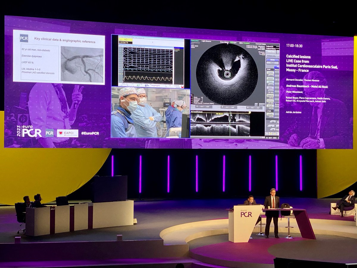Shockwave Medical (@shockwaveivl) on Twitter photo Two calcified nodules down thanks to #ShockwaveC2plus in this live case at #EuroPCR! Excellent #ShockwaveIVL result by Drs Bernard Chevalier & <a href="/DrThomasHovasse/">Dr Thomas Hovasse</a> from Massy using all 120 pulses to modify nodular calcium. #40extraforthewin
ISI bit.ly/3iEq7fC #CardioTwitter Two calcified nodules down thanks to #ShockwaveC2plus in this live case at #EuroPCR! Excellent #ShockwaveIVL result by Drs Bernard Chevalier & <a href="/DrThomasHovasse/">Dr Thomas Hovasse</a> from Massy using all 120 pulses to modify nodular calcium. #40extraforthewin
ISI bit.ly/3iEq7fC #CardioTwitter