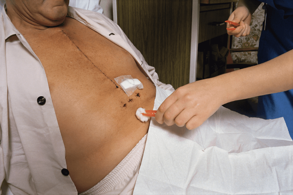 TheKHClinic's tweet photo. ๐๐ง๐๐๐ซ๐ฌ๐ญ๐๐ง๐๐ข๐ง๐ ๐๐๐ฒ๐ก๐จ๐ฅ๐ ๐๐๐๐ซ๐ญ ๐๐ฎ๐ซ๐ ๐๐ซ๐ฒ: ๐๐ก๐ ๐๐๐ฌ๐ฌ ๐๐ง๐ฏ๐๐ฌ๐ข๐ฏ๐ ๐๐ฉ๐ญ๐ข๐จ๐ง ๐๐จ๐ซ ๐๐๐๐ซ๐ญ ๐๐๐ญ๐ข๐๐ง๐ญ๐ฌ.ย https://t.co/OfcrnJMO9Y #keyholeheartsurgery #heartsurgery #cardiacsurgery #heart #cardiology #openheartsurgery #cardiologist https://t.co/wAA0loBOos