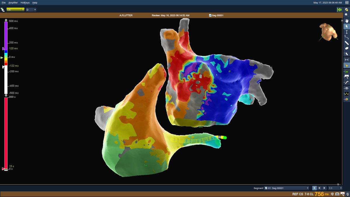 mertilkerh's tweet photo. 58 y,F with incessant SVT wthout #ablation history. I guessed it is CTI dependent from #ECG. Surprise! Here it is #EPeeps #CardioTwitter ablation of microreentry and RPVs isolation solved the problem @AbbottNews @ataseverosmann @vebedu @NurigunayEP @altankaptan48 https://t.co/L0digx6eaE