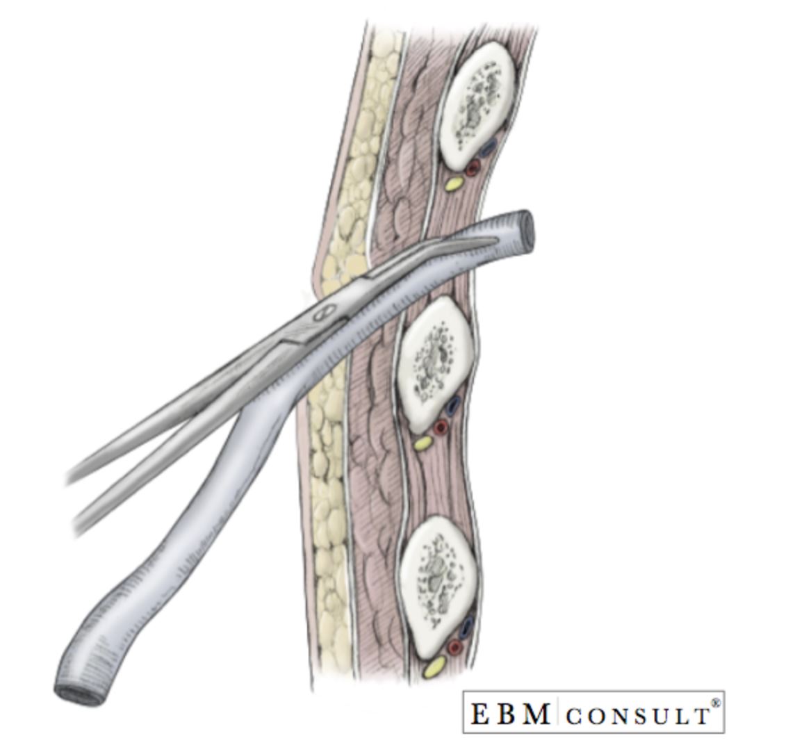 Kelly Clamp Chest Tube