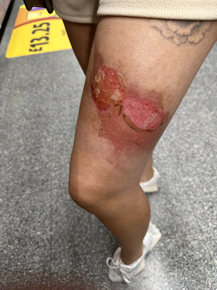 MR_ROYROY's tweet photo. @VirginAtlantic spills boiling coffee over my partners leg on our way to vegas once in a lifetime trip. Holiday ruined for us, upgraded seats on the way home and they want to take no further action? Something doesn’t seem fair @shaiweiss https://t.co/Mqq5ajvFKY