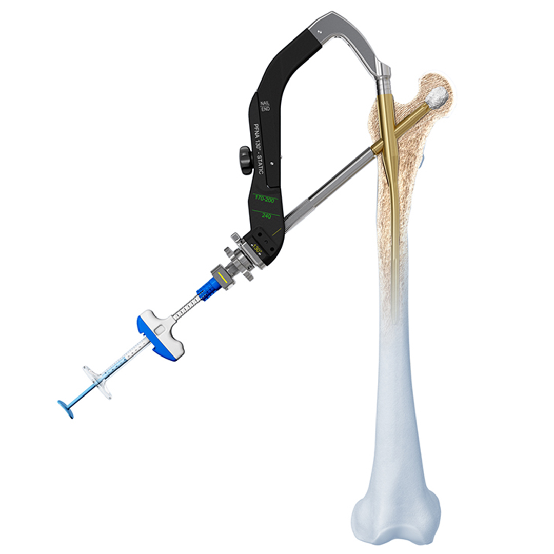 On this #InnovationsFriday we focus on the cost-effectiveness of cement augmentation for the fixation of unstable trochanteric fractures.

📝Analysis: Christian Kammerlander, MD, Julia Schneller, MD, AO ITC Clinical Science, and DePuy Synthes👉 fal.cn/3ynYq