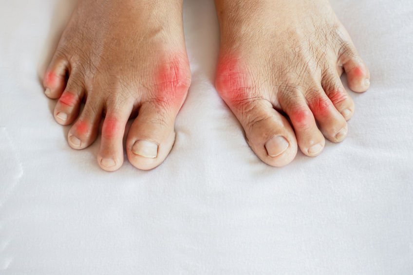 SyracuseFeet's tweet photo. Are you suffering from foot pain due to your bunion? Treatment and relief is possible! Visit our website or call our office today to learn more. https://t.co/eB1mp6Q96K https://t.co/DubW1XeKnK