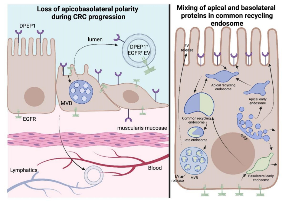 👋Interested in the connections between #GPI-anchored proteins and their #extracellular carriers in #colorectal cancer? 
👀See the new review from <a href="/SciComSarah/">Sarah E. Glass</a> <a href="/RobertJCoffey/">Robert J. Coffey</a> <a href="/VUMCDiscoveries/">Vanderbilt University Medical Center</a> just out in <a href="/EVCNA/">りくと</a>.
🔗evcna.com/article/view/5…
#biomarkers #exosomes