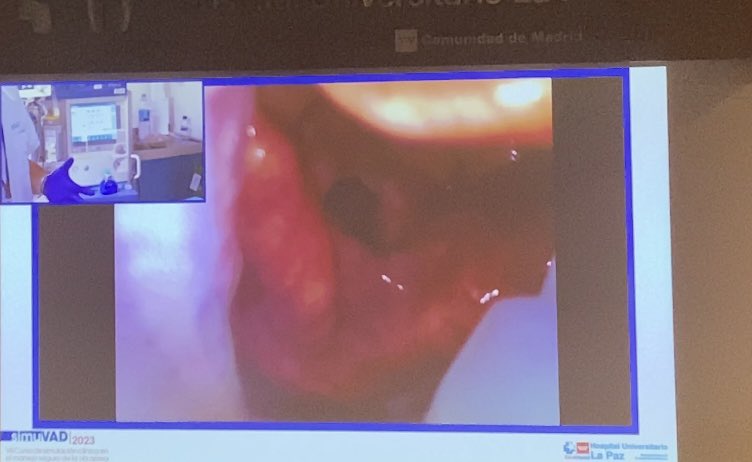 Gracias SIMUVAD Madrid 2023. Gracias Dr Miguel Astrain Aguado y al Complejo Hospitalario de Cartagena (España)  #VisionMask y #PMH aumentando aún más la seguridad en los quirófanos del territorio nacional. Ventilación de rutina bajo visión continua. VM 5 accesos
