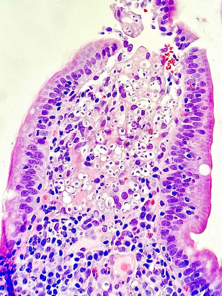 What fungal infection is seen in this biopsy of the small intestine of an immunocompromised patient? Answer &amp; additional stain: buff.ly/3yEAmaZ
#PathArt #PathTwitter #IDTwitter #MedTwitter