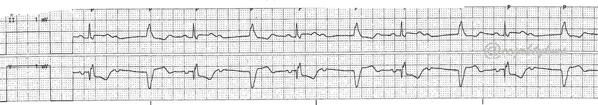 051923

From the📦/📧 by a 🫂
#ECGChallenge
Difficulty level (out of 5⭐️): ⭐️⭐️⭐️
 
What is your  ECG dx? Poll next

#MedEd 
#MedTwitter 
#CardioTwitter 
#EPeeps