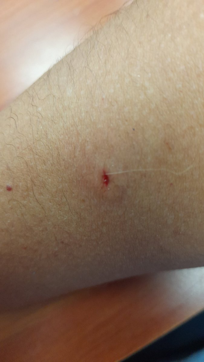 jajedadoseaman's tweet photo. Buen día, tengan cuidado por  Padre Solano cerca de la Iglesia San Agustin,un loco hachero de raza negra me acaba de hincar en el brazo,yo creía q me había tropezado con algo pero al verme  sangre,cuidado @PoliciaEcuador @ecu911sambo @Cupsfire_gye https://t.co/MOQYBfAcZu