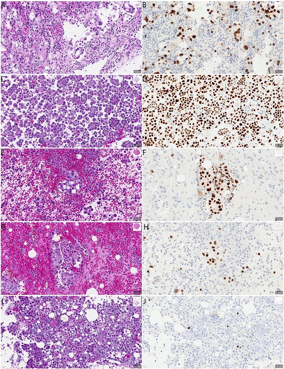 🔬  SOX17 is a highly sensitive and specific marker for detecting metastatic gynecologic carcinomas in cytology specimens. Visit the new article by @SatturawarSwati, <a href="/Aparwani_dpath/">Anil Parwani</a>, <a href="/LiZaibo/">Zaibo Li</a>, et al to explore this new marker.

🔗 acsjournals.onlinelibrary.wiley.com/doi/full/10.10…

#CytoPath
#GynPath
