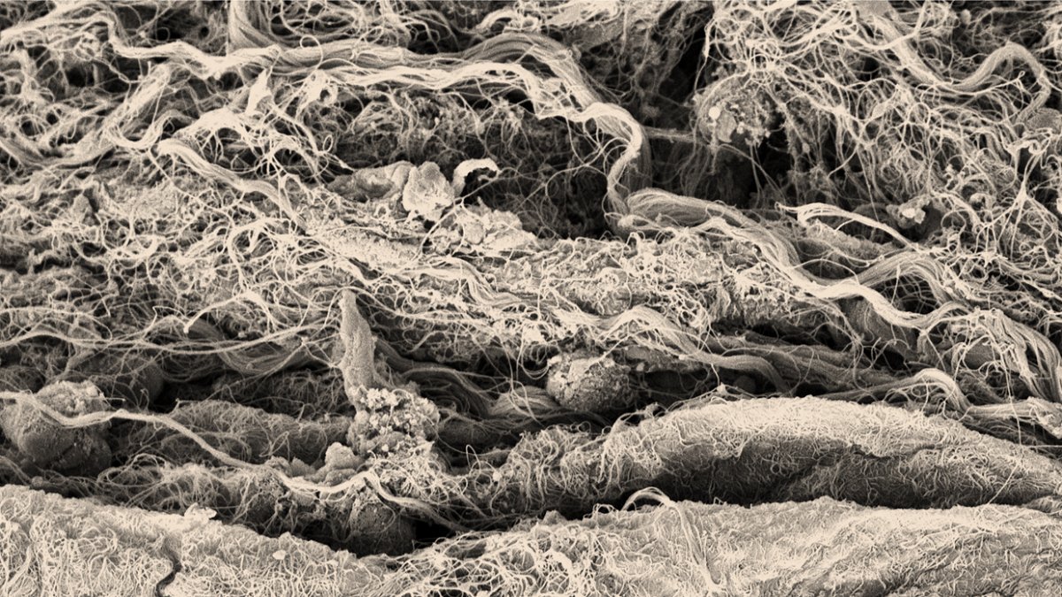 Nature Communications (@naturecomms) on Twitter photo In this study, using a decellularized tissue model of ovarian cancer metastasis, the authors demonstrate that the extracellular matrix educates tumour-associated macrophages with an immunoregulatory phenotype. <a href="/DrEllyTyler/">Elly Tyler</a>, <a href="/pearce_lab/">Pearce Lab</a>, <a href="/LImmunotherapy/">Heinz Läubli</a>
nature.com/articles/s4146… In this study, using a decellularized tissue model of ovarian cancer metastasis, the authors demonstrate that the extracellular matrix educates tumour-associated macrophages with an immunoregulatory phenotype. <a href="/DrEllyTyler/">Elly Tyler</a>, <a href="/pearce_lab/">Pearce Lab</a>, <a href="/LImmunotherapy/">Heinz Läubli</a>
nature.com/articles/s4146…
