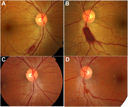 Hyperemic optic discs, telangiectasias, thickened peripapillary retinal nerve fiber layer, and perivenous hemorrhages as part of the presenting symptoms of post-bariatric surgery #wernicke #encephalopathy. #thiamine #retina @Hopitaux_unige @GEBrvz ow.ly/xGvP50Oc04s