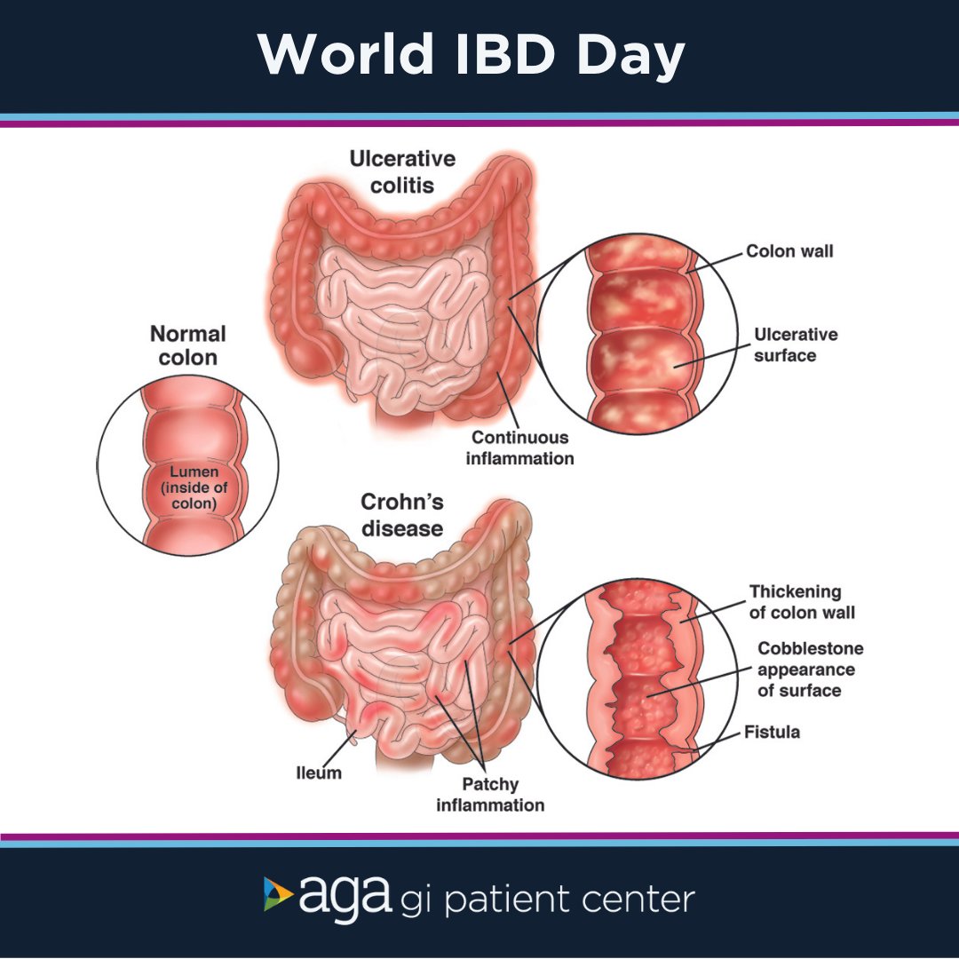 We’re working to make #IBDvisible on #WorldIBDDay, and every day. Today we recognize #IBDwarriors across the 🌎, and the doctors and researchers working to treat and care for the #IBD community. Visit the AGA #GI Patient Center for more: ow.ly/2OkR50Optfx.