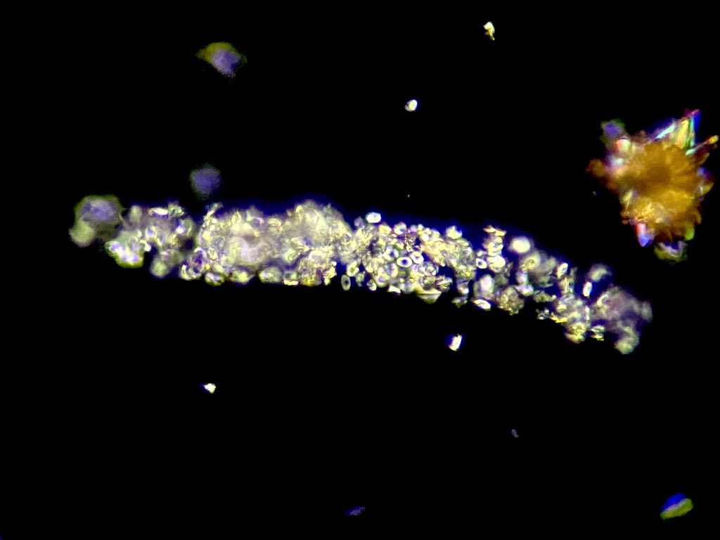 Cilindros con inclusiones de cristales de Oxalato de Calcio Monohidratado 🔬 

-Microscopia de Luz Polarizada 40x
-Microscopia de Campo Claro 40x 

Este tipo de cilindros indican que se han precipitado cristales dentro de la luz tubular.  #urinemicroscopy