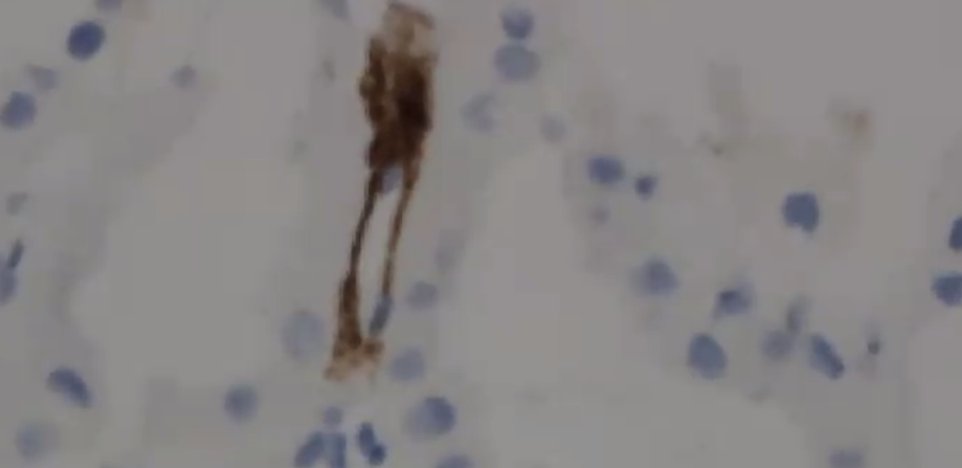 ssfarouk's tweet image. Peritubular capillaritis +C4d peritibular capillary staining in a #kidneytransplant, with acute antibody mediated rejection 

#KidneyPath