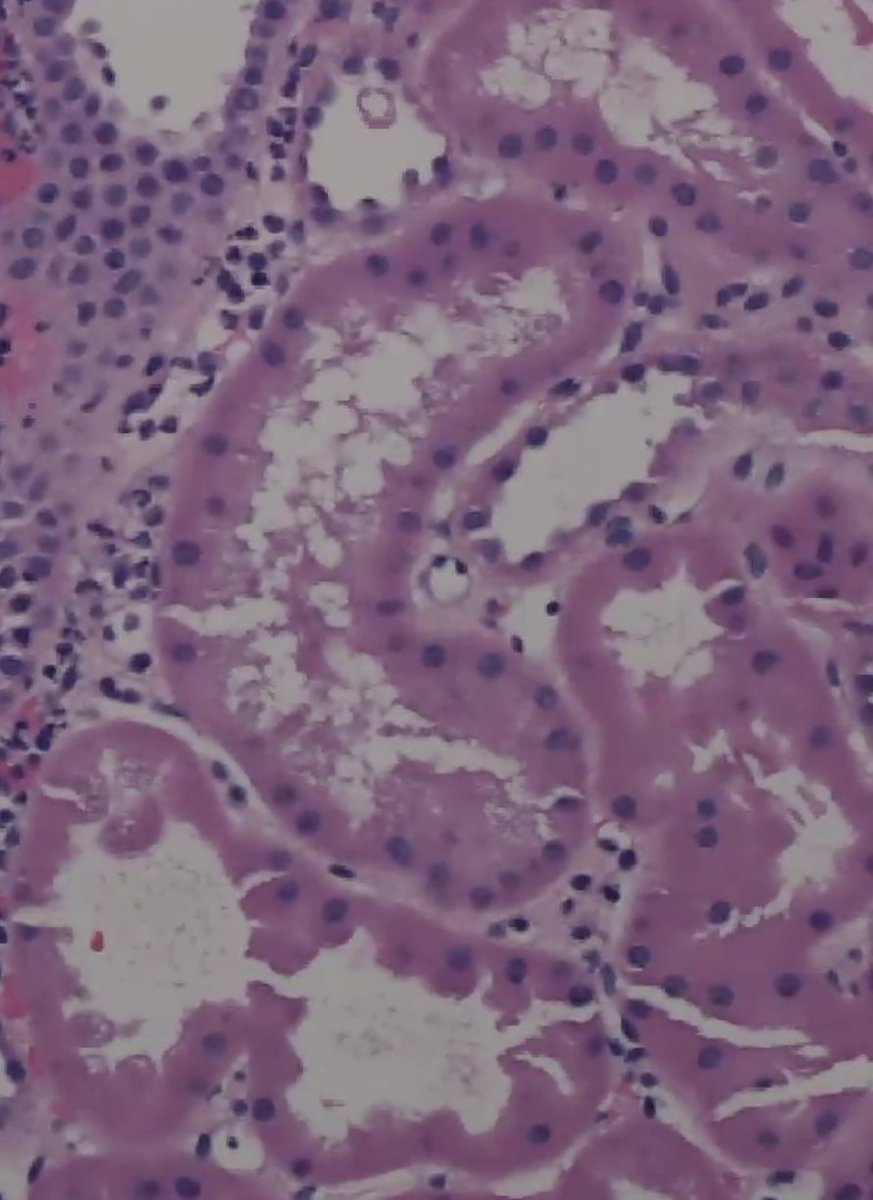 ssfarouk's tweet image. Peritubular capillaritis +C4d peritibular capillary staining in a #kidneytransplant, with acute antibody mediated rejection 

#KidneyPath