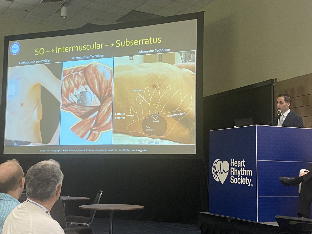 Tips and tricks in S-ICD implantation by @rdschaller in #HRS2023 
Great step by step explanation 
I am ready for the first case #2023PaceSetter