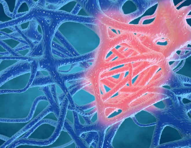 Neurology Today (@neurologytoday) on Twitter photo Via <a href="/ANA_journals/">ANA Journals</a>: Immune therapies targeting specific aspects of the innate immune system may help patients with cryptogenic new-onset refractory #StatusEpilepticus: bit.ly/3ML4lG9
#neurotwitter #NORSE @AANMember Via <a href="/ANA_journals/">ANA Journals</a>: Immune therapies targeting specific aspects of the innate immune system may help patients with cryptogenic new-onset refractory #StatusEpilepticus: bit.ly/3ML4lG9
#neurotwitter #NORSE @AANMember