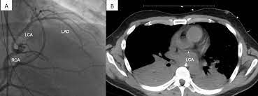UPMC Heart and Vascular Institute (@hviupmc) on Twitter photo Utilization of cardiac graft with single coronary artery for orthotopic heart transplantation <a href="/NicholasHessMD/">Nicholas Hess</a> Mary Keebler <a href="/CarlyFabrizio/">Carly Fabrizio</a> David Kaczorowski <a href="/UPMC_CTSurgery/">Pitt Cardiothoracic Surgery Department</a> <a href="/JournalCTSurg/">Journal of Cardiothoracic Surgery</a> #CardioTwitter #PubMed #CTSurgery #MedEd #Transplant
pubmed.ncbi.nlm.nih.gov/36401286/ Utilization of cardiac graft with single coronary artery for orthotopic heart transplantation <a href="/NicholasHessMD/">Nicholas Hess</a> Mary Keebler <a href="/CarlyFabrizio/">Carly Fabrizio</a> David Kaczorowski <a href="/UPMC_CTSurgery/">Pitt Cardiothoracic Surgery Department</a> <a href="/JournalCTSurg/">Journal of Cardiothoracic Surgery</a> #CardioTwitter #PubMed #CTSurgery #MedEd #Transplant
pubmed.ncbi.nlm.nih.gov/36401286/