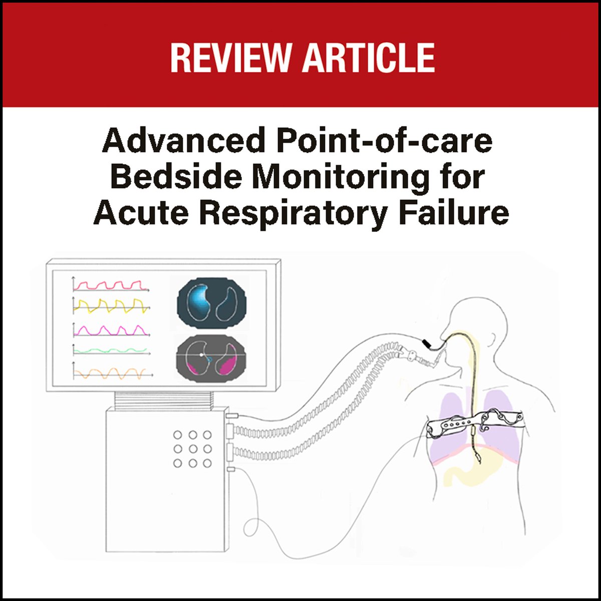 Advanced respiratory #monitoring involves several mini- or noninvasive tools, applicable at bedside, that have the potential to support clinicians in the management of acute respiratory failure. Learn more about the personalization of ventilatory strategy: ow.ly/rLgH50OrZNg