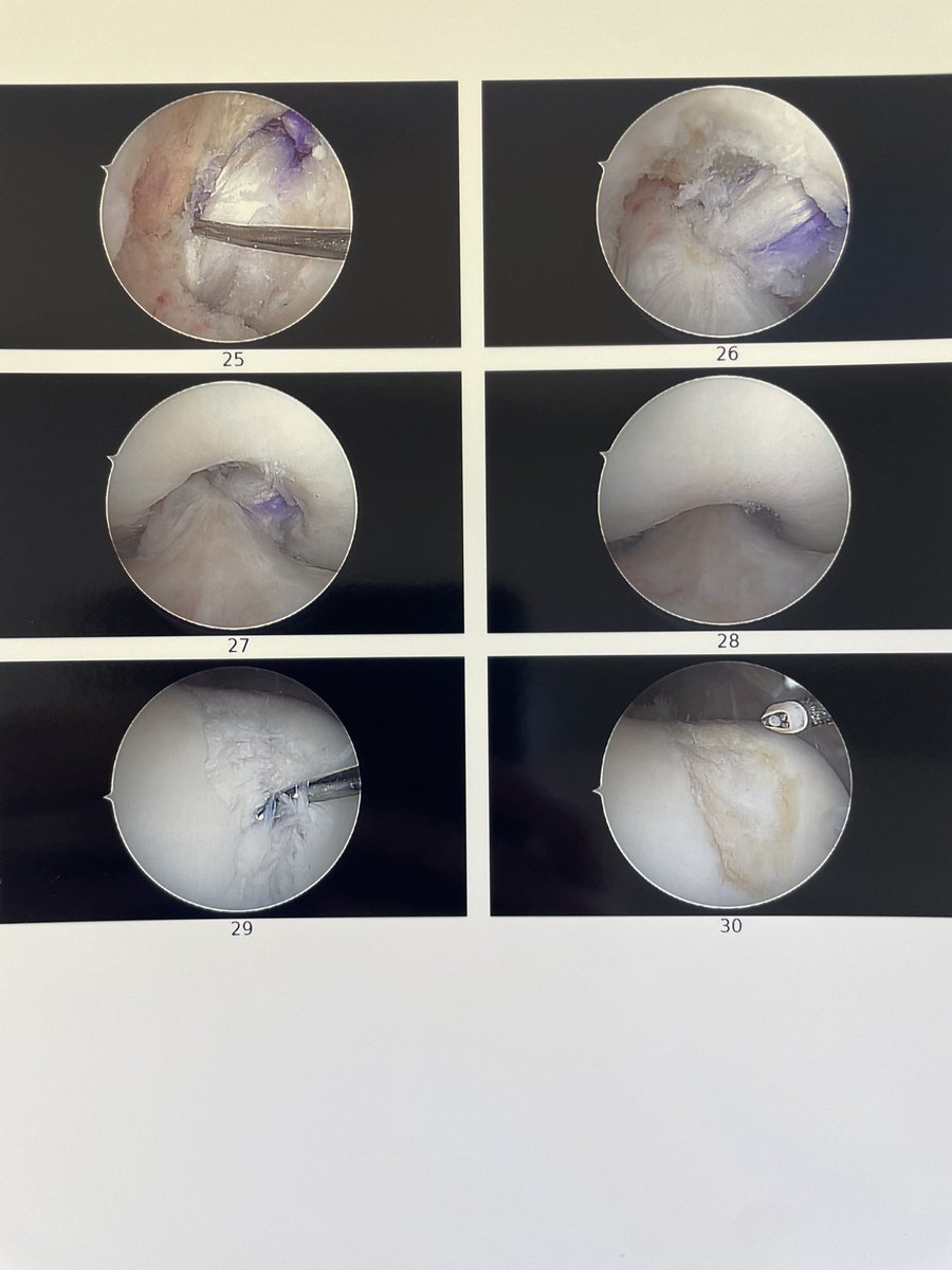 kneedoc74's tweet photo. #PCL Friday….isolated PCL recon today @leedshipknee ….very satisfying both for patient, and of course surgeon! #PCL #pclreconstruction #ligamentsurgery #theleedsknee #theleedskneeclinic https://t.co/qw9Qx7N23z