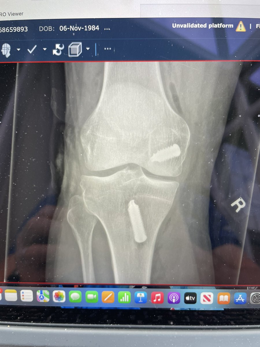 kneedoc74's tweet photo. And the post-op XRs https://t.co/SW6whiGpf5
