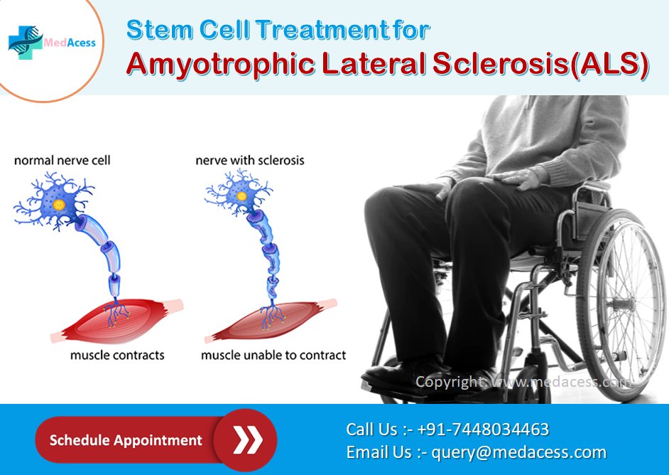 Amyotrophic Lateral Sclerosis (#ALS), also known as Lou Gehrig's disease, is a progressive #neurodegenerative #disorder that affects #nervecells responsible for controlling voluntary muscles...

Visit - 123articleonline.com/articles/13482…