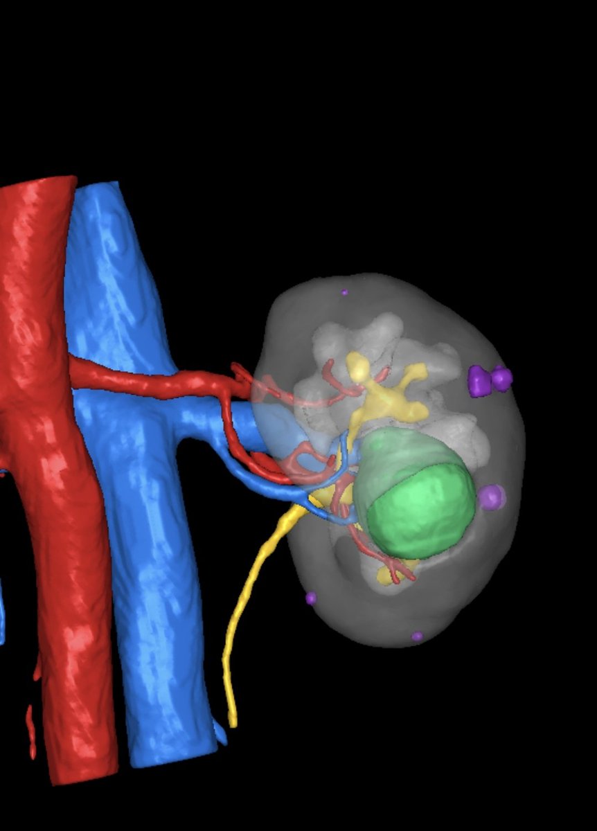 Mohammed Aldiwani (@moaldiwani) on Twitter photo Absolutely loving the now routine use of <a href="/innersightlabs/">innersightlabs</a> 3D models for robotic partial nephrectomy. Helped the <a href="/FrimleyRCC/">Frimley Renal Cancer Centre</a> team with some tricky cases in the past few weeks! <a href="/mmalki01/">Manar Malki</a> <a href="/MHussainUrol/">Muddassar Hussain</a> #partialnephrectomy #3dmodeling Absolutely loving the now routine use of <a href="/innersightlabs/">innersightlabs</a> 3D models for robotic partial nephrectomy. Helped the <a href="/FrimleyRCC/">Frimley Renal Cancer Centre</a> team with some tricky cases in the past few weeks! <a href="/mmalki01/">Manar Malki</a> <a href="/MHussainUrol/">Muddassar Hussain</a> #partialnephrectomy #3dmodeling