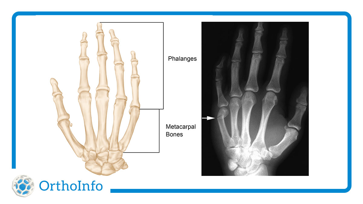 AAOS1's tweet image. The bad news: @padres star @Manny_Machado13 suffered a fracture when he was hit on the hand by a pitch Monday. The good news: #HandFractures often heal well w/out surgery. Learn more about treatment &amp;amp; recovery at #OrthoInfo: bit.ly/3KWt3zV @MLB @HandSociety #OrthoTwitter