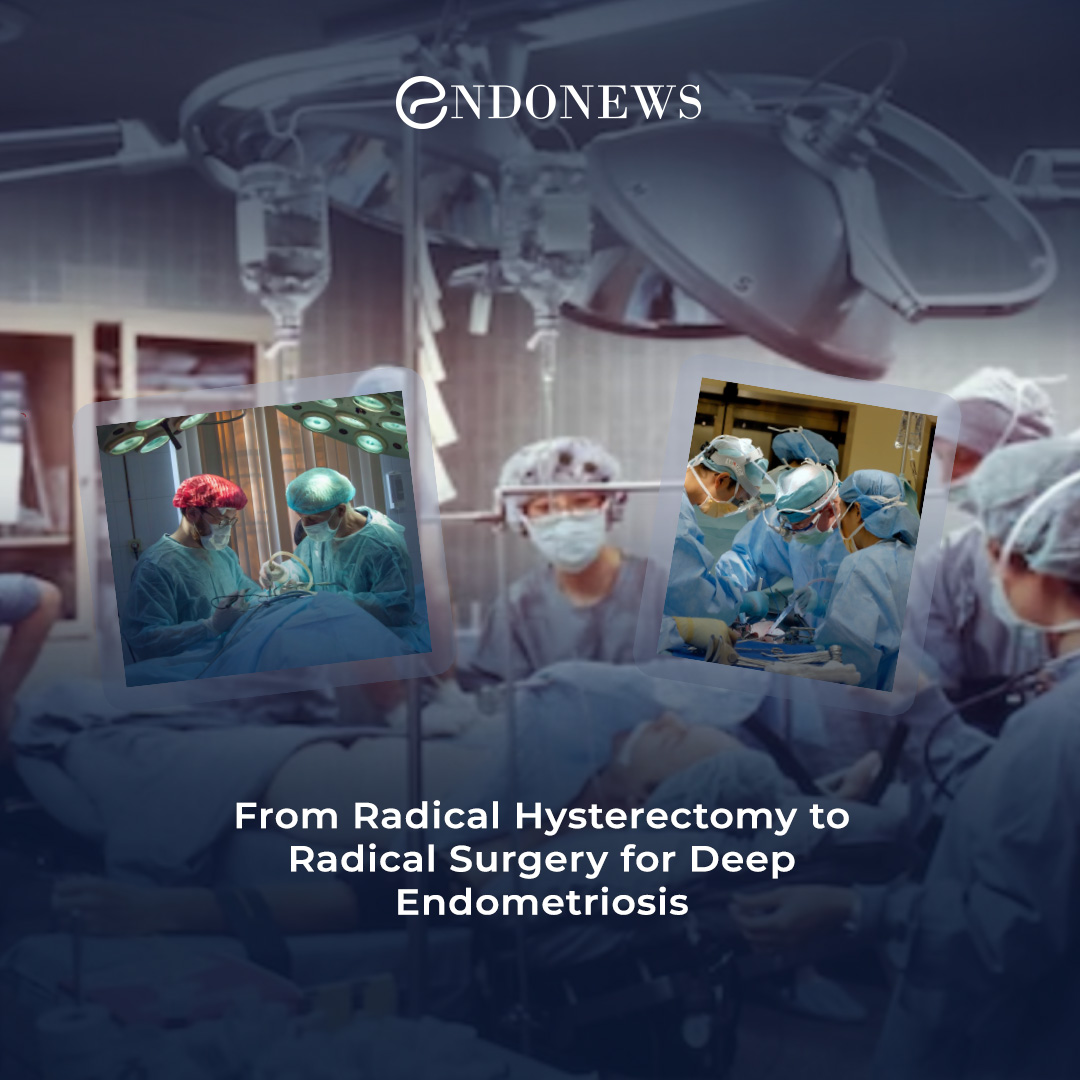 Laparoscopic radical hysterectomy techniques are promising for the cure of deeply invasive endometriosis.

Read More:
endonews.com/surgery-for-de…

#deeplyinfiltratedendometriosis #radicalhysterectomy #openabdomensurgery #minimallyinvasivesurgery...