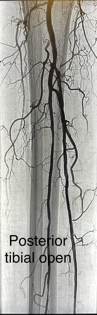 dr_ashishg's tweet image. Patient in late 80s, non healing ulcers and ischemic pain in right leg. Complex multivessel tibial and pedal revascularization with #IVUS guidance, #Laseratherectomy and balloon angioplasty. Joys of limb salvage.@AMPSymposium @CLI_Global @Vascupedia_com