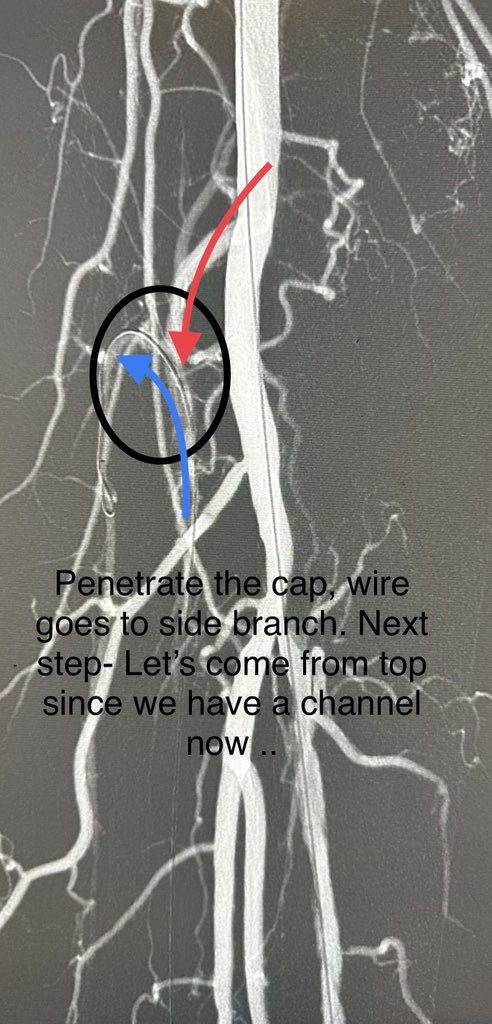 dr_ashishg's tweet image. Patient in late 80s, non healing ulcers and ischemic pain in right leg. Complex multivessel tibial and pedal revascularization with #IVUS guidance, #Laseratherectomy and balloon angioplasty. Joys of limb salvage.@AMPSymposium @CLI_Global @Vascupedia_com