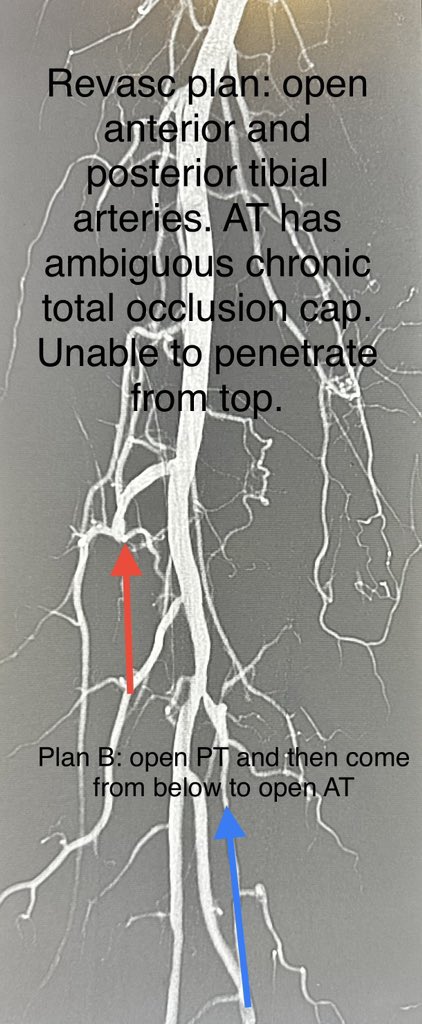 dr_ashishg's tweet image. Patient in late 80s, non healing ulcers and ischemic pain in right leg. Complex multivessel tibial and pedal revascularization with #IVUS guidance, #Laseratherectomy and balloon angioplasty. Joys of limb salvage.@AMPSymposium @CLI_Global @Vascupedia_com